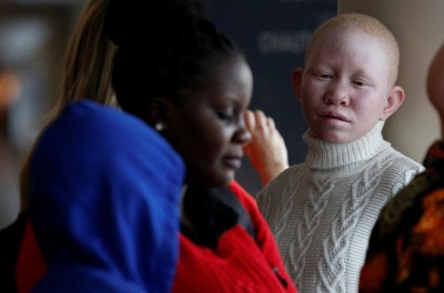 امرأة تنزانية مصابة بالمهق تزور الولايات المتحدة لتلقي الرعاية الطبية، في مطار جون كنيدي الدولي في مدينة نيويورك بالولايات المتحدة في 25 آذار/ مارس 2017. رويترز/ بريندان ماكديرميد