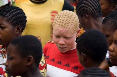 Photo of an albinism attack victim