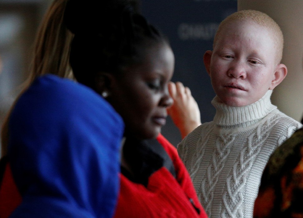 A Tanzanian woman with albinism visiting the U.S. for medical care, arrives at JFK International Airport in New York City, U.S., March 25, 2017. REUTERS/Brendan McDermid