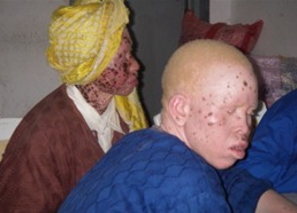 Two persons with Albinism