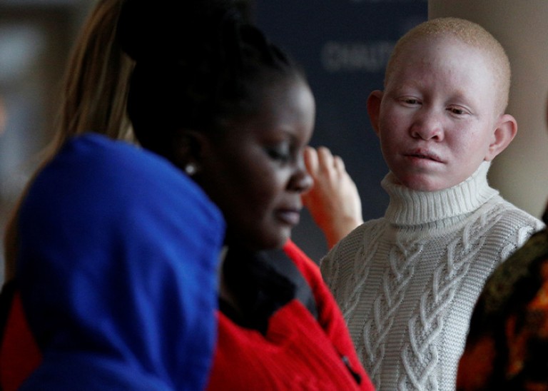 A Tanzanian woman with albinism visiting the U.S. for medical care, arrives at JFK International Airport in New York City, U.S., March 25, 2017. REUTERS/Brendan McDermid