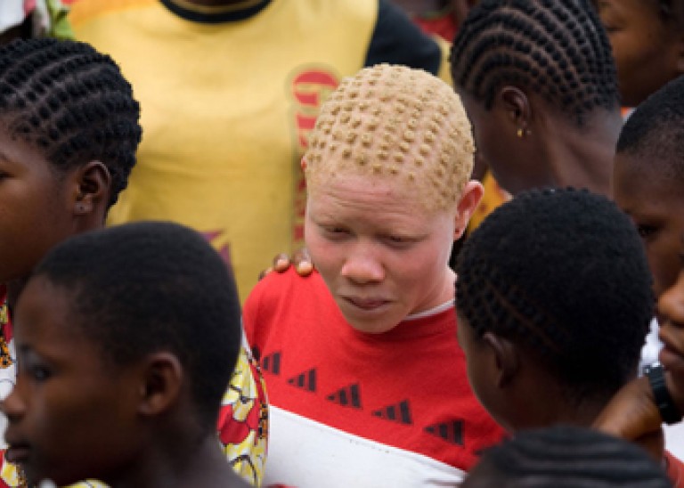 AlbinismAttackVictim